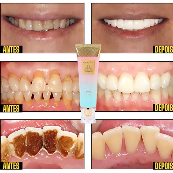 PastaClean - Remova TODAS Imperfeições Bucais | COMPRE 1 LEVE 2 + Frete GRÁTIS – imagem 6