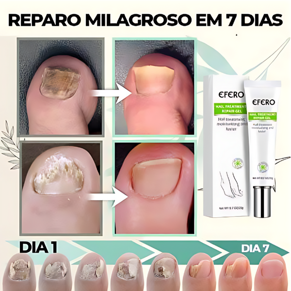 Efero Nails - Removedor de Fungos/Micoses + Fortalecimento das Unhas |COMPRE 2 LEVE 3| Frete Grátis – imagem 6