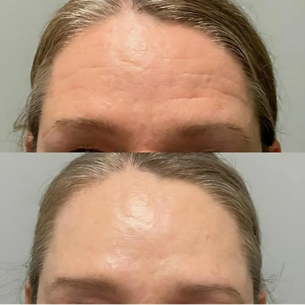 BotoxFace PREMIUM - Retire Imperfeições Faciais | COMPRE 1 LEVE 2 + Frete GRÁTIS – imagem 5