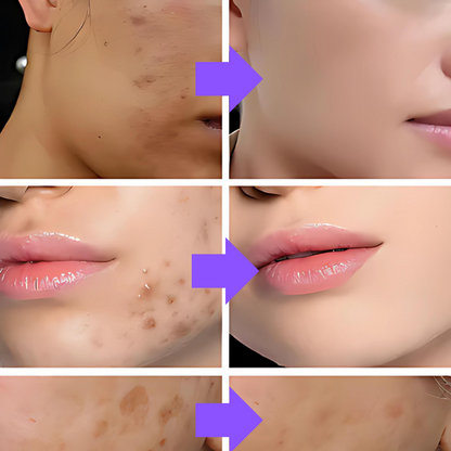 Máscara de Colágeno Verisol - Retire Imperfeições Faciais |COMPRE 1 LEVE 3|Frete Grátis