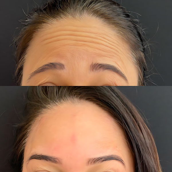 BotoxFace PREMIUM - Retire Imperfeições Faciais | COMPRE 1 LEVE 2 + Frete GRÁTIS