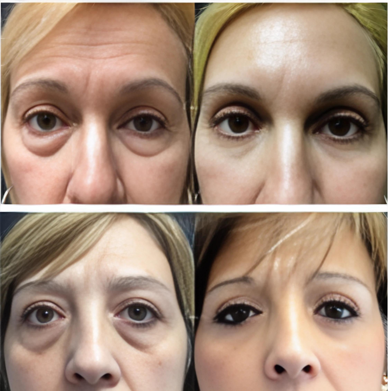 Máscara de Colágeno Verisol - Retire Imperfeições Faciais |COMPRE 1 LEVE 3|Frete Grátis – imagem 10
