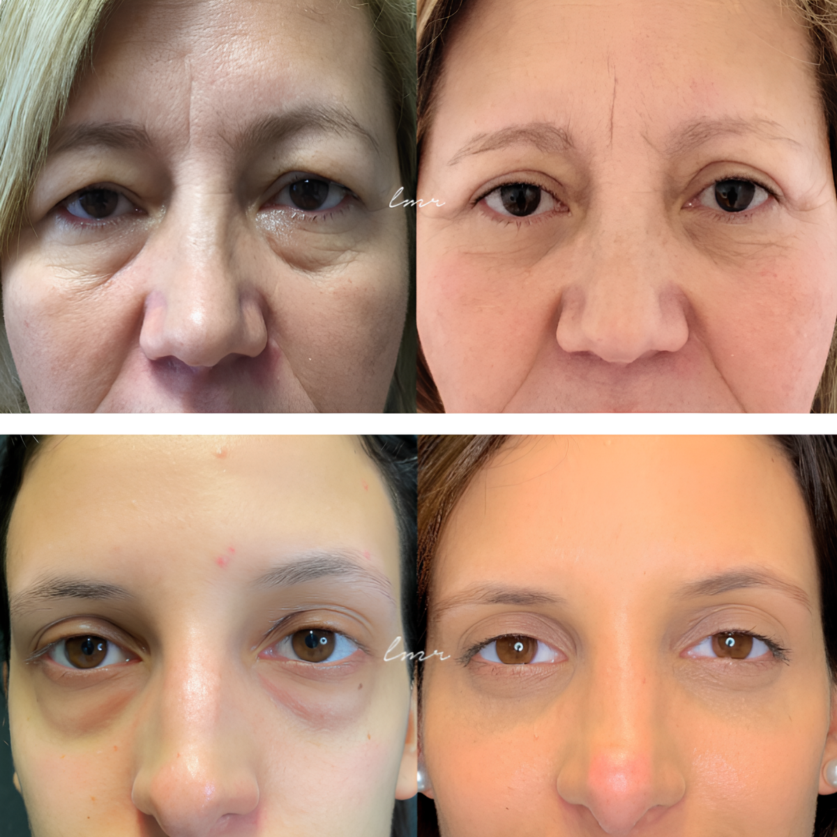 COMPRE 1 LEVE 2 - VisionSkin™ 3D  Remove Bolsas , Anti-Envelhecimento, Rugas e Inchaço – imagem 3