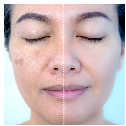 Máscara de Colágeno Verisol - Retire Imperfeições Faciais |COMPRE 1 LEVE 3|Frete Grátis