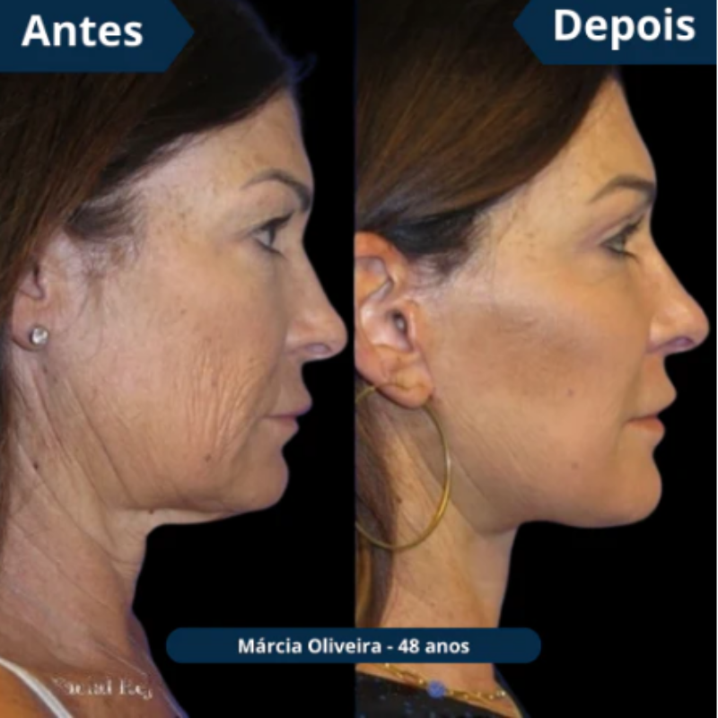 Máscara de Colágeno Verisol - Retire Imperfeições Faciais |COMPRE 1 LEVE 3|Frete Grátis – imagem 7